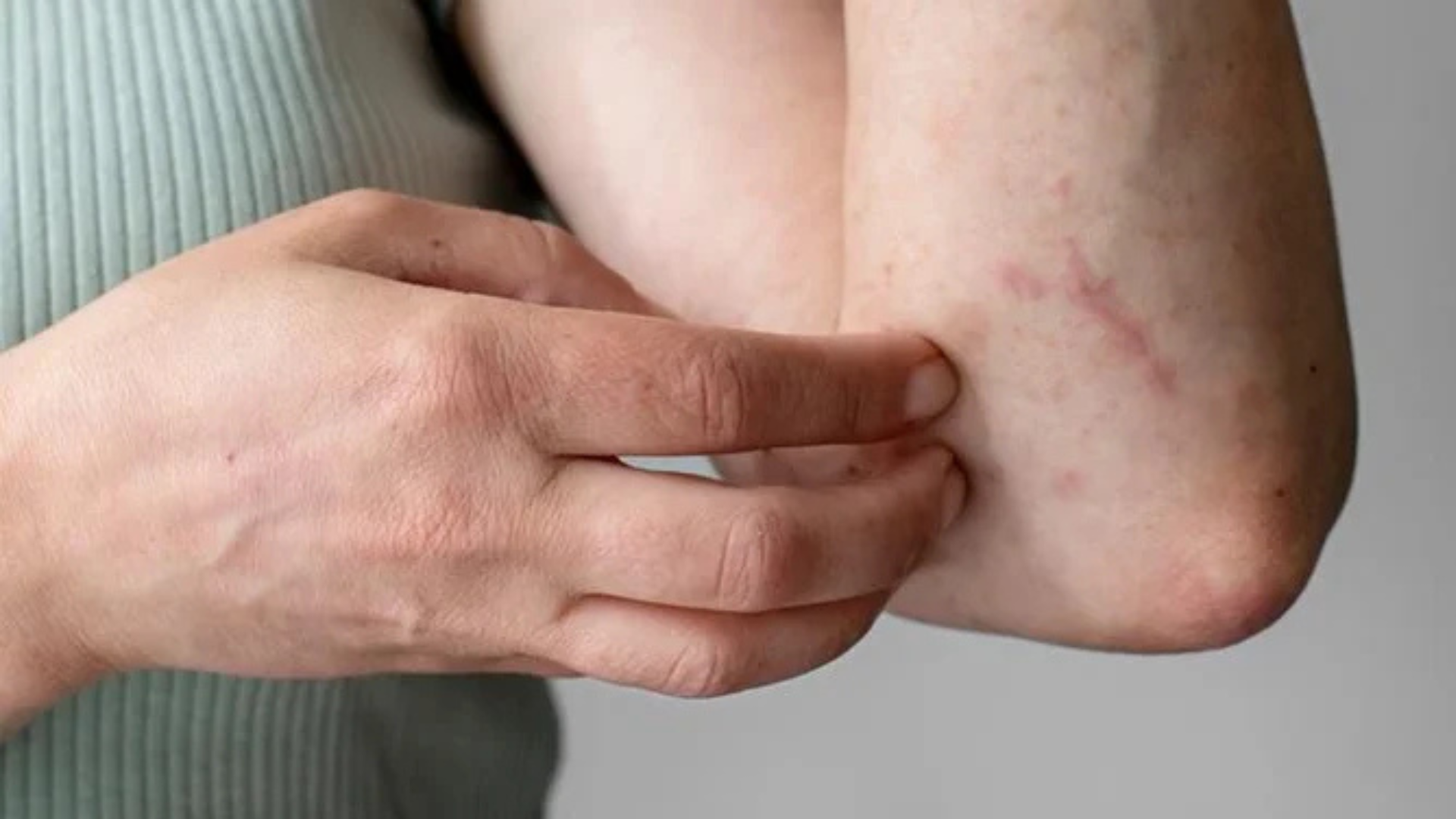 SUS passa a oferecer tratamento integral para dermatite atópica