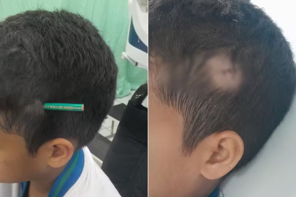 Estudante crava lápis na cabeça de colega após briga dentro de escola