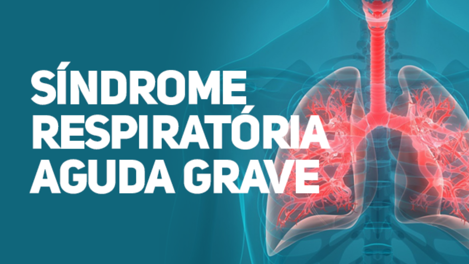 Painel de Hospitalizações de Síndrome Respiratória Aguda indicam que 34 pacientes foram internados em Panambi neste ano, com 02 óbitos por Covid