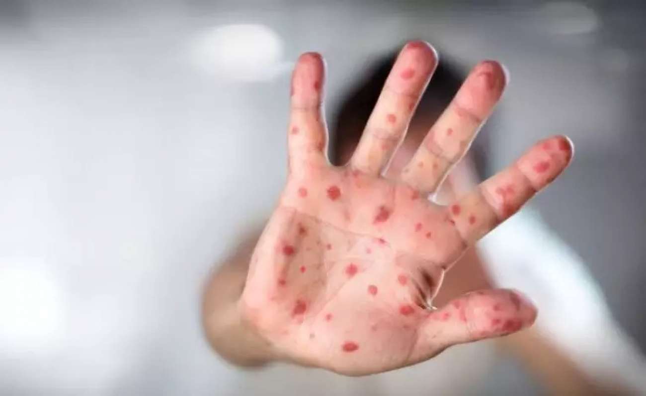 Rio Grande do Sul acende alerta contra sarampo e recomenda vacinação